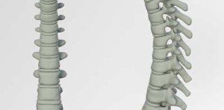stenosi del canale vertebrale