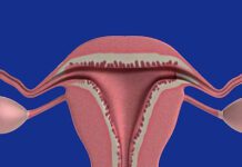 cervicite cura